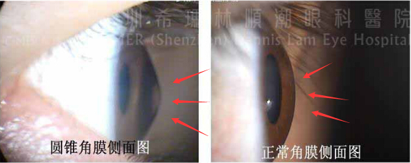 圓錐角膜患者角膜會(huì)慢慢變薄并向外凸出，導(dǎo)致近視或散光度數(shù)變化、嚴(yán)重時(shí)可能引起角膜水腫，影響視力