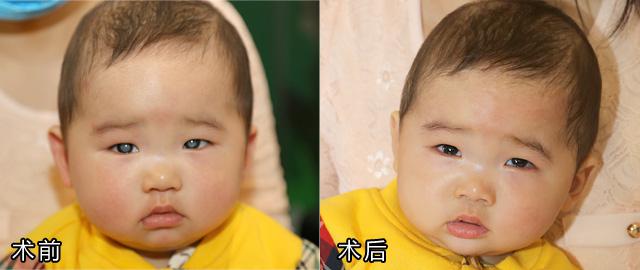 小兒白內(nèi)障患兒——小洛陽(yáng)術(shù)前及術(shù)后天